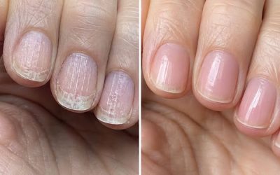 Soak your nails in this 1 mixture and get rid of brittle ridges, vertical lines, and flaky layers