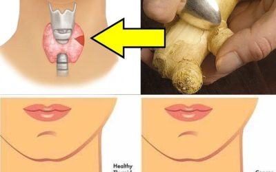 19 Foods to Avoid with Thyroid Problems